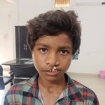 चिरायु’ दल ने लौटाई मुस्कान, जन्मजात कटे होंठ और तालु से मिली मुक्ति….